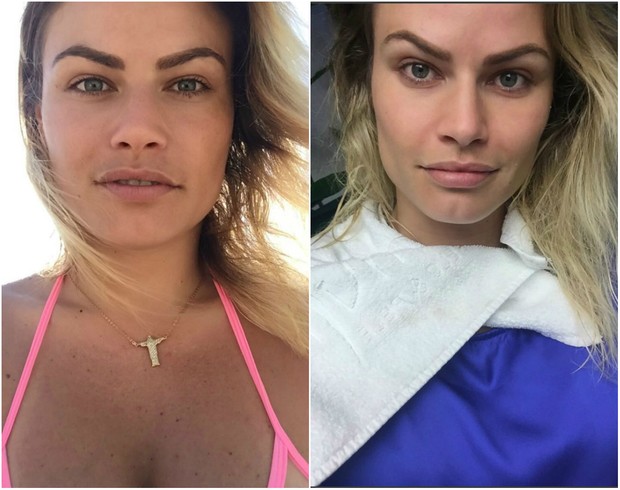 Com 31 anos, a ex-BBB Natalia Casassola fez Bichetomia em agosto de 2016. Com apenas 7 dias de pós-cirúrgico, ela mostrou o antes e o depois nas redes sociais. 